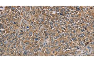 Immunohistochemistry of paraffin-embedded Human ovarian cancer tissue using NDUFS7 Polyclonal Antibody at dilution 1:40 (NDUFS7 抗体)