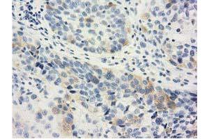 Immunohistochemical staining of paraffin-embedded Carcinoma of Human bladder tissue using anti-LIN7B mouse monoclonal antibody. (LIN7B 抗体)