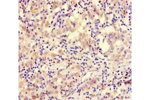 Immunohistochemistry of paraffin-embedded human lung cancer using ABIN7171083 at dilution of 1:100 (SMARCE1 抗体  (AA 20-243))