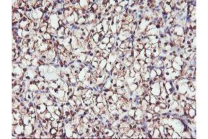 Immunohistochemical staining of paraffin-embedded Carcinoma of Human kidney tissue using anti-SERPINB6 mouse monoclonal antibody. (SERPINB6 抗体)