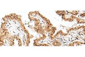 Immunohistochemistry of paraffin-embedded Human thyroid cancer tissue using FAM84B Polyclonal Antibody at dilution of 1:70(x200) (FAM84B 抗体)