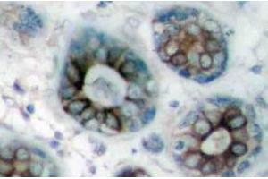Immunohistochemistry (IHC) analyzes of GAP43 antibody in paraffin-embedded human breast carcinoma tissue.