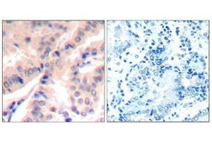 Immunohistochemical analysis of paraffin-embedded human lung carcinomatissue using eIF4B(Phospho-Ser422) Antibody(left) or the same antibody preincubated with blocking peptide(right). (EIF4B 抗体  (pSer422))