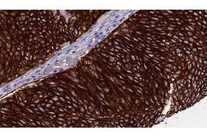 ABIN6276368 at 1/100 staining Human urothelial cancer tissue by IHC-P.