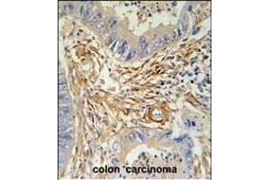 PRB2 Antibody (C-term) (ABIN6244055 and ABIN6578967) immunohistochemistry analysis in formalin fixed and paraffin embedded human colon carcinoma followed by peroxidase conjugation of the secondary antibody and DAB staining. (PRB2 抗体  (C-Term))