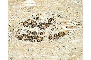 IHC analysis of FFPE human breast carcinoma with HER3 antibody (ERBB3 抗体  (AA 24-55))