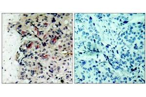 Immunohistochemical analysis of paraffin-embedded human breast carcinoma tissue using JAK1 (Ab-1022) antibody (E021119). (JAK1 抗体)