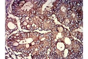 Immunohistochemical analysis of paraffin-embedded rectum cancer tissues using CD46 mouse mAb with DAB staining. (CD46 抗体  (AA 35-179))