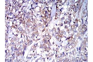 Immunohistochemical analysis of paraffin-embedded breast cancer tissues using IghA1 mouse mAb with DAB staining. (IGHA1 抗体  (AA 207-353))