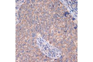 Immunohistochemistry of paraffin-embedded human breast cancer using CTNN Rabbit mAb (ABIN7266135) at dilution of 1:100 (40x lens). (CTNNA3 抗体)