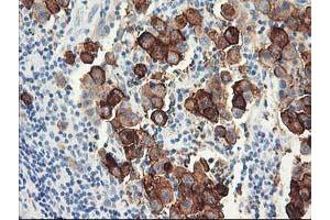 Immunohistochemical staining of paraffin-embedded Carcinoma of Human lung tissue using anti-DPP10 mouse monoclonal antibody. (DPP10 抗体)