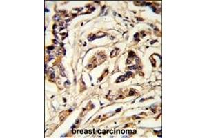 Formalin-fixed and paraffin-embedded human breast carcinoma reacted with TSHB Antibody (Center), which was peroxidase-conjugated to the secondary antibody, followed by DAB staining. (TSHB 抗体  (AA 58-86))