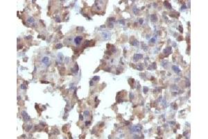 Formalin-fixed, paraffin-embedded human Histiocytoma stained with TNF alpha antibody (TNFA/1172) (TNF alpha 抗体)