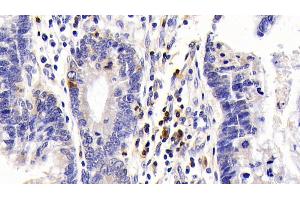 Detection of IL7R in Human Colorectal cancer Tissue using Polyclonal Antibody to Interleukin 7 Receptor (IL7R)