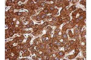 IHC-P Image Immunohistochemical analysis of paraffin-embedded human hepatoma, using LSS, antibody at 1:500 dilution. (LSS 抗体)