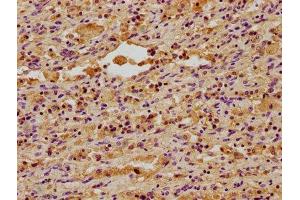 IHC image of ABIN7150498 diluted at 1:400 and staining in paraffin-embedded human lung cancer performed on a Leica BondTM system. (DNAJA3 抗体  (AA 86-184))