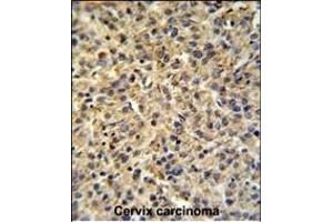 TPRGL Antibody (N-term) (ABIN651274 and ABIN2840164) IHC analysis in formalin fixed and paraffin embedded human cervix carcinoma tissue followed by peroxidase conjugation of the secondary antibody and DAB staining. (TPRG1L 抗体  (N-Term))