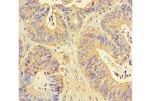 Immunohistochemistry of paraffin-embedded human colon cancer using ABIN7150594 at dilution of 1:100 (RPN1 抗体  (AA 44-427))