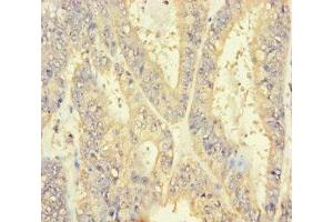 Immunohistochemistry of paraffin-embedded human endometrial cancer using ABIN7151338 at dilution of 1:100 (INSL4 抗体  (AA 30-139))