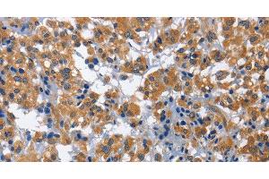 Immunohistochemistry of paraffin-embedded Human thyroid cancer using HSF27 Polyclonal Antibody at dilution of 1:60 (CDK5RAP3 抗体)