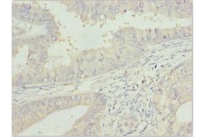 Immunohistochemistry of paraffin-embedded human endometrial cancer using ABIN7144060 at dilution of 1:100 (ZFAND3 抗体  (AA 1-227))