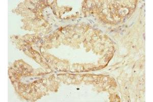 Immunohistochemistry of paraffin-embedded human prostate cancer using ABIN7162350 at dilution of 1:100 (GPR68 抗体  (AA 276-365))