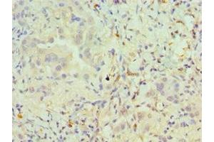 Immunohistochemistry of paraffin-embedded human lung cancer using ABIN7162504 at dilution of 1:100 (PAX6 抗体  (AA 1-300))