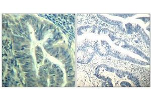 Immunohistochemical analysis of paraffin-embedded human colon carcinoma tissue using CDK6(Phospho-Tyr24) Antibody(left) or the same antibody preincubated with blocking peptide(right). (CDK6 抗体  (pTyr24))