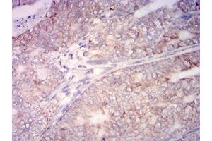 Immunohistochemical analysis of paraffin-embedded cervical cancer tissues using CYCS mouse mAb with DAB staining.