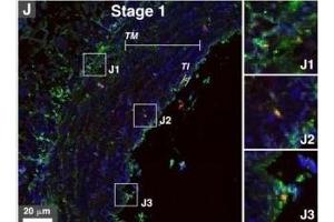 Immunohistological staining of artery tissues from diabetic subjects showing colocalization of serum proteins and mineral deposits.