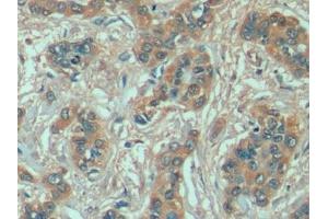 Detection of HSPA1A in Human Liver cancer Tissue using Anti-Heat Shock 70 kDa Protein 1A (HSPA1A) Monoclonal Antibody (HSP70 1A 抗体  (AA 285-641))