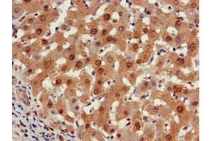 Immunohistochemistry of paraffin-embedded human liver cancer using ABIN7164960 at dilution of 1:100 (PSMA5 抗体  (AA 124-180))