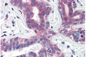 Human Breast (formalin-fixed, paraffin-embedded) stained with XBP1 antibody ABIN337110 at 5 ug/ml followed by biotinylated anti-goat IgG secondary antibody ABIN481715, alkaline phosphatase-streptavidin and chromogen. (XBP1 抗体  (AA 358-372))
