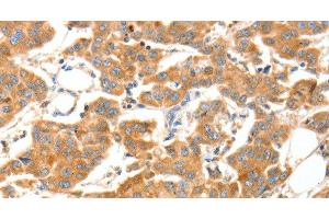 Immunohistochemistry (Paraffin-embedded Sections) (IHC (p)) image for anti-ADAM Metallopeptidase with thrombospondin Type 1 Motif, 18 (ADAMTS18) antibody (ABIN7240418)