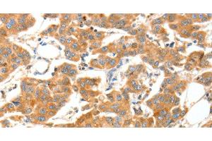 Immunohistochemistry of paraffin-embedded Human breast cancer tissue using ADAMTS18 Polyclonal Antibody at dilution 1:30 (ADAMTS18 抗体)