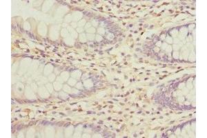 Immunohistochemistry of paraffin-embedded human colon cancer using ABIN7163881 at dilution of 1:100 (GALNT2 抗体  (AA 442-571))