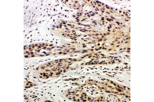 Anti-Caspase-14 antibody, IHC(P) IHC(P): Human Oesophagus Squama Cancer Tissue (CASP14 抗体  (C-Term))