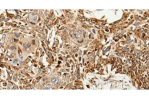 Immunohistochemistry of paraffin-embedded Human esophagus cancer tissue using SLC9A7 Polyclonal Antibody at dilution 1:60 (NHE7 抗体)