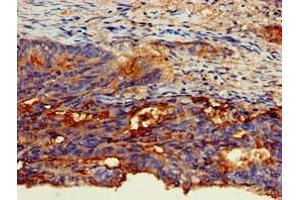 Immunohistochemistry of paraffin-embedded human colon cancer using ABIN7146803 at dilution of 1:100 (CEACAM6 抗体  (AA 35-320))