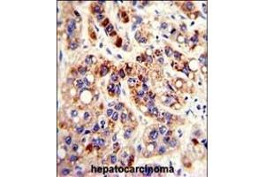 Formalin-fixed and paraffin-embedded human hepatocarcinoma with PON3 Antibody (N-term), which was peroxidase-conjugated to the secondary antibody, followed by DAB staining. (PON3 抗体  (N-Term))