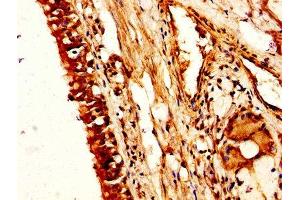 IHC image of ABIN7161954 diluted at 1:200 and staining in paraffin-embedded human lung cancer performed on a Leica BondTM system. (NUCB2 抗体  (AA 25-106))