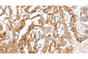 Immunohistochemistry of paraffin-embedded Human thyroid cancer using ACY3 Polyclonal Antibody at dilution of 1:35 (Aminoacylase 3 抗体)
