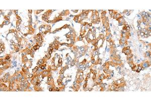 Immunohistochemistry of paraffin-embedded Human thyroid cancer using ACY3 Polyclonal Antibody at dilution of 1:35 (Aminoacylase 3 抗体)