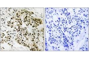 Immunohistochemistry analysis of paraffin-embedded human breast carcinoma tissue, using Retinoblastoma (Ab-252) Antibody. (Retinoblastoma Protein (Rb) 抗体  (AA 221-270))