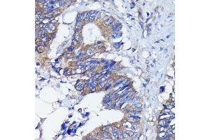 Immunohistochemistry of paraffin-embedded human colon carcinoma using PKC alpha antibody (ABIN6128460, ABIN6135858, ABIN6135859 and ABIN7101370) at dilution of 1:100 (40x lens). (PKC alpha 抗体)