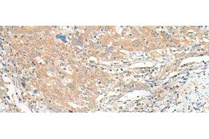 Immunohistochemistry of paraffin-embedded Human cervical cancer tissue using SLC6A9 Polyclonal Antibody at dilution of 1:25(x200)