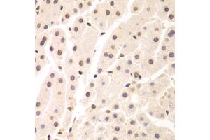 Immunohistochemistry of paraffin-embedded human liver cancer using UHRF2 antibody. (UHRF2 抗体)