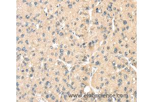 Immunohistochemistry of Human liver cancer using LOXL3 Polyclonal Antibody at dilution of 1:35