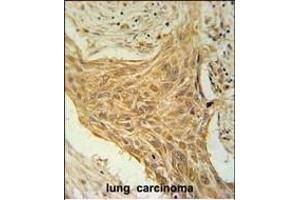 CSAG2 Antibody (N-term) (ABIN651616 and ABIN2840327) immunohistochemistry analysis in formalin fixed and paraffin embedded human lung carcinoma followed by peroxidase conjugation of the secondary antibody and DAB staining. (CSAG2 抗体  (N-Term))