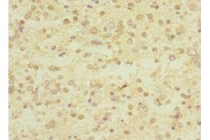 Immunohistochemistry of paraffin-embedded human glioma using ABIN7174375 at dilution of 1:100 (UBE4A 抗体  (AA 797-1066))
